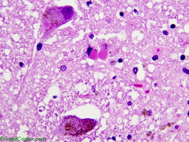 Extraneuronal Lewy bodies, H&E stain X 600